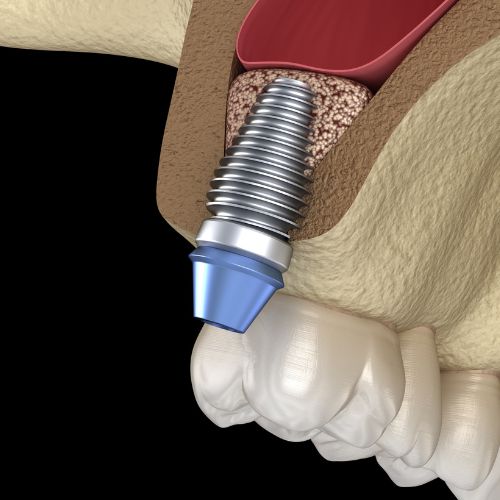 Chirurgie préimplantaire dentiste belleville sur meuse